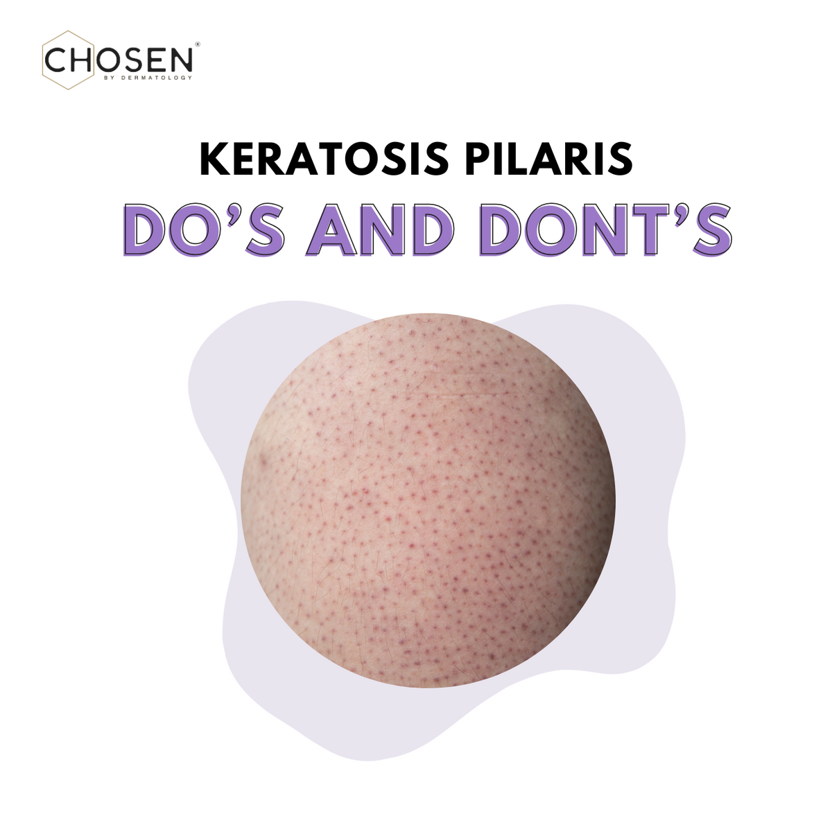 Do&rsquo;s and Dont&rsquo;s if you have Keratosis Pilaris – CHOSEN Store