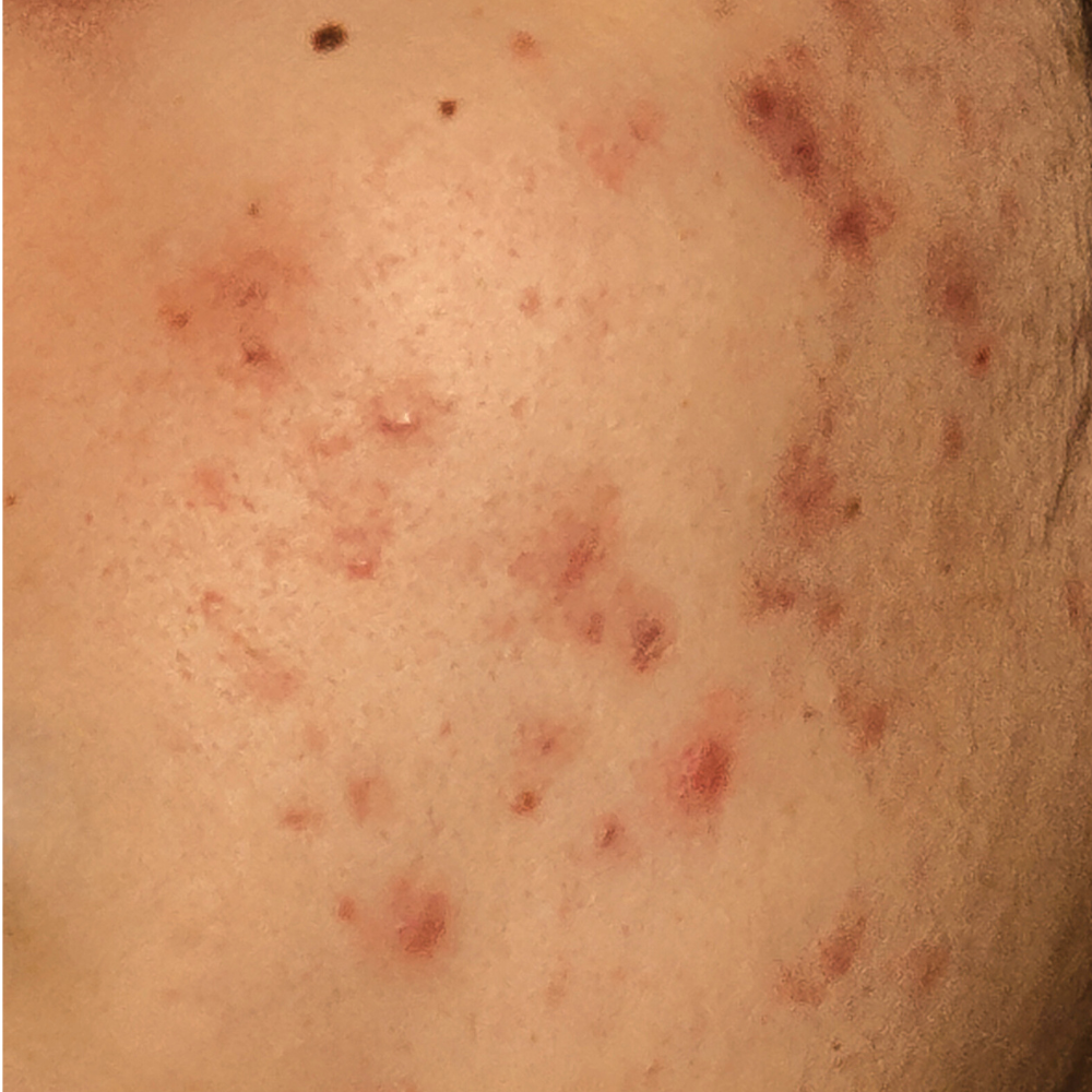Acne_89d139f4-186b-4d19-bcf8-d273f3c9c35e.png