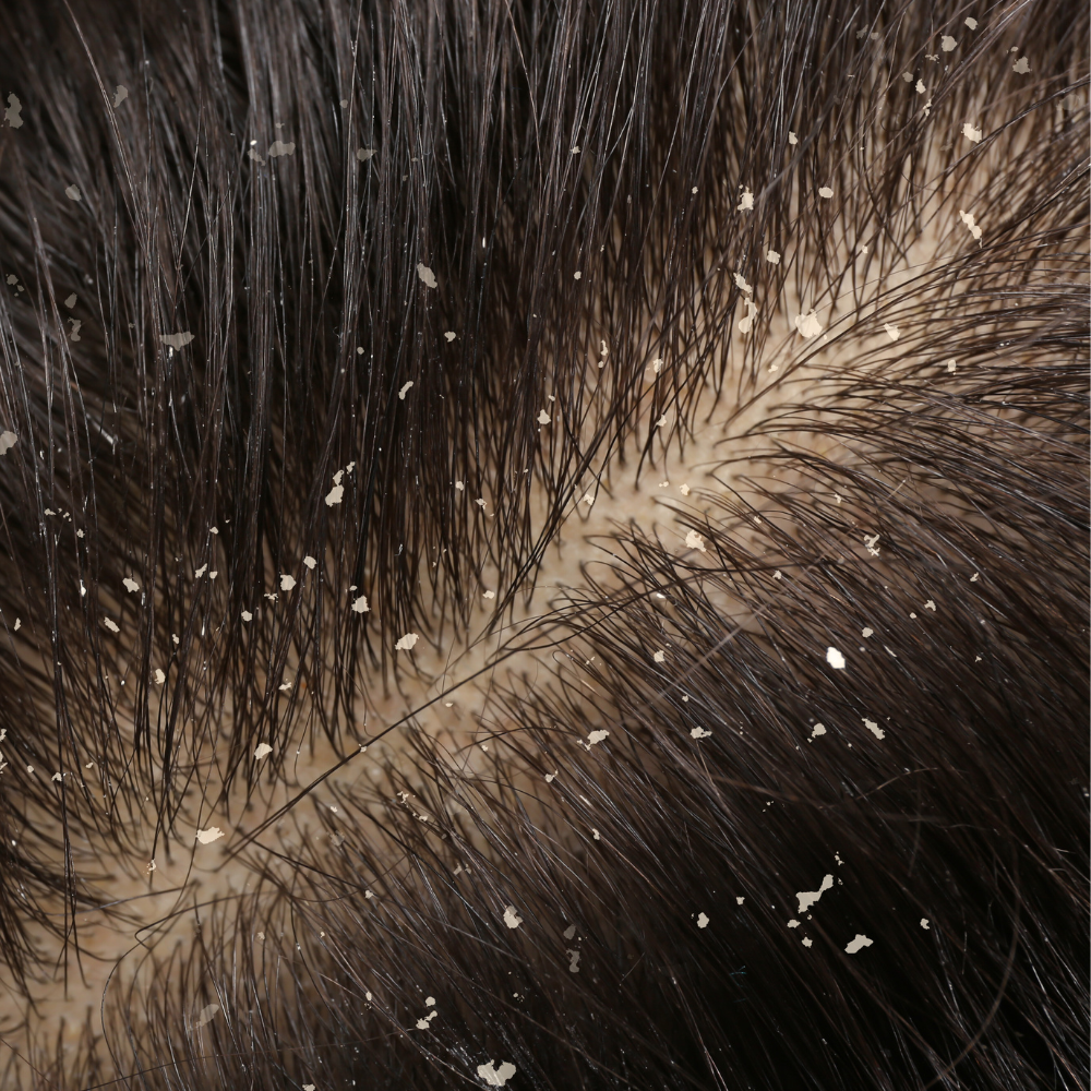 Dandruff.png