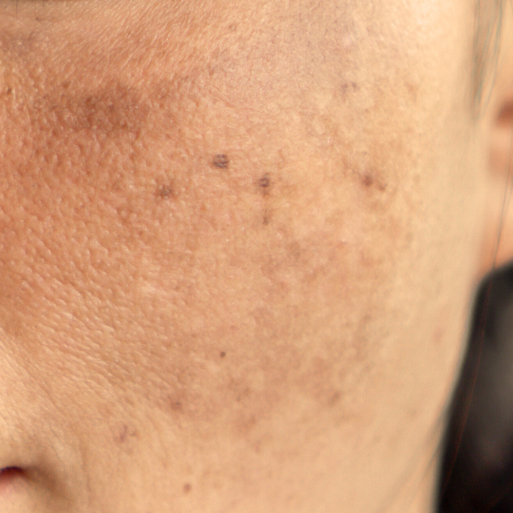 Melasma_a1be6560-395b-43f3-a8e1-fedf32a2187c.png