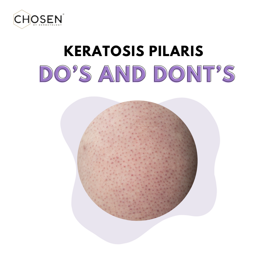 Keratosis Pilaris  Do’s and Dont’s