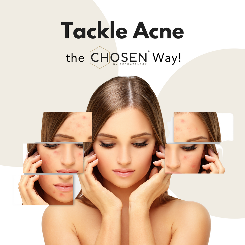 How to get rid of Acne?