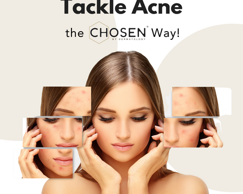 How to get rid of Acne?