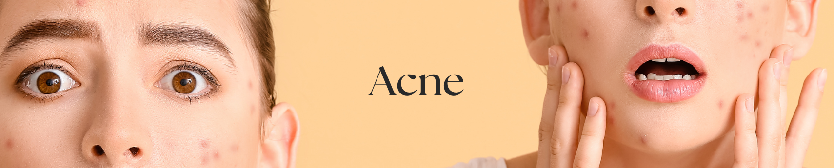 Effective anti-acne skincare products