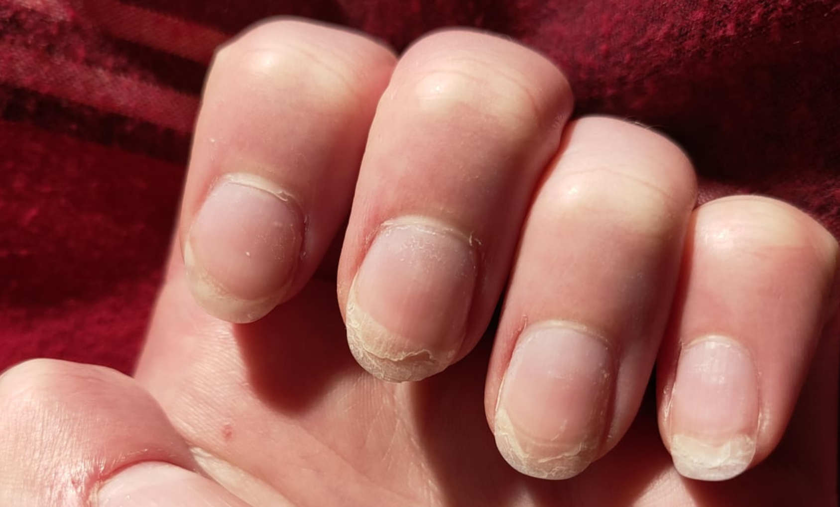 Brittle Nails