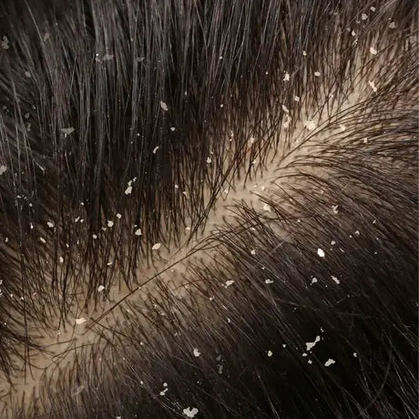 Dandruff.webp