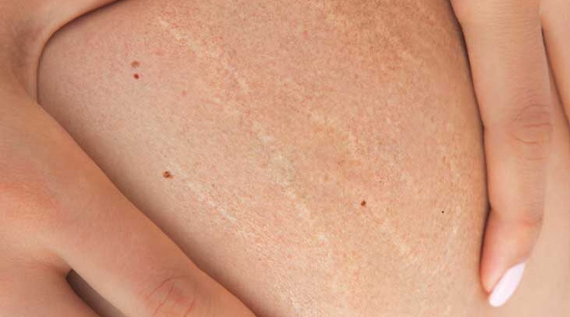 Dry and Stretched Skin
