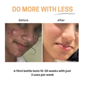 Light Routine® Easy Salicylic Acid Peel